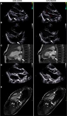 Treatment decision in a 4-year-old-boy with left ventricular outpouching after advanced hemodynamical flow evaluation with 4Dflow CMR: A case report